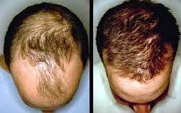 ছেলেদের মাথায় বেশি টাক পড়ে কেন?